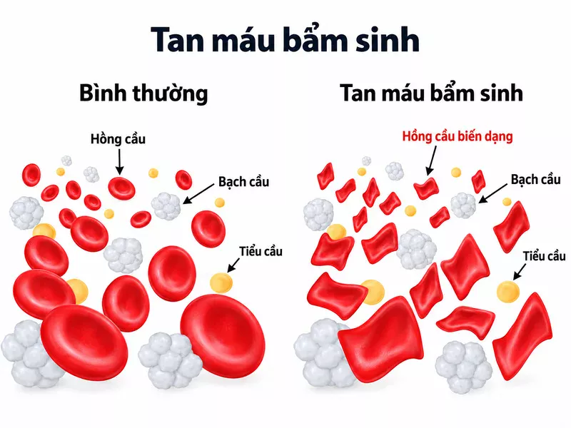 Tan máu bẩm sinh ảnh hưởng đến quá trình tạo hemoglobin